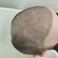 Пересадка волос FUE